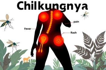 chikungunya